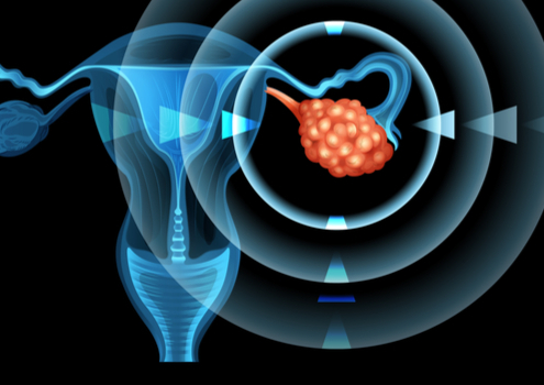 Ovarian Cancer