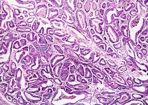 Micrograph, colon cancer