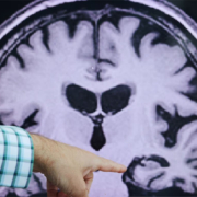 Alzheimer's disease, brain scan