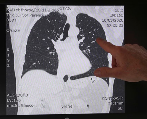 lungs, scanner